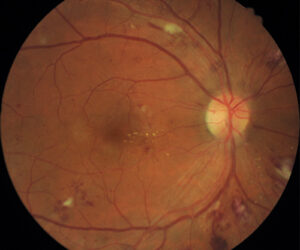 right-eye-retina-of-patient-with-diabetic-retinopathy-copy.jpg